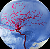 Arterial aneurysm