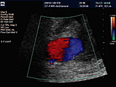 False aneurysm,Doppler ultrasound