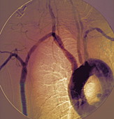 Blood vessel graft,X-ray