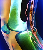 Knee thrombosis,X-ray