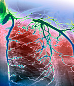 Takayasu's disease,X-ray