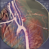 Blocked artery,X-ray