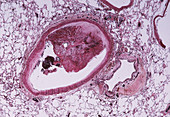 Pulmonary artery blood clot