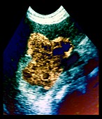 Blood vessel tumour,ultrasound scan