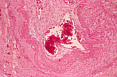 Thrombus in an artery,light micrograph
