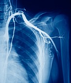 Arterial stenosis,X-ray