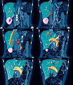Thrombosis of the portal vein,CT scan