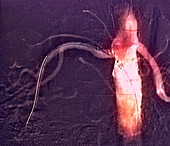 Renal angioplasty,X-ray