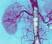 Arterial stent,X-ray