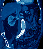 Abdominal aortic aneurysm,CT scan