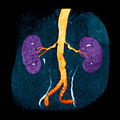 Narrowed renal arteries,MRI scan