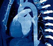 Aortic aneurysms,CT scan
