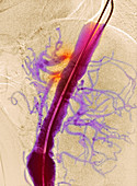 Narrowed arteries,X-ray