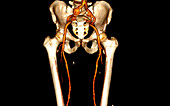 Iliac aneurysm,CT scan