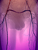 Arterial bypass,angiogram