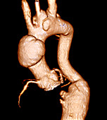 Aortic aneurysms,3D CT scan