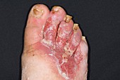 Infected ischaemic toes