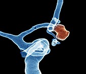 Carotid aneurysm,angiogram