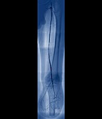 Arteritis of the leg,angiogram