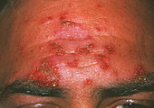 Impetigo skin infection