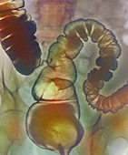 Irritable bowel syndrome,X-ray