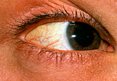 Yellowing of sclera of eye due to jaundice