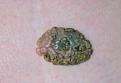 Close-up of a seborrhoeic keratosis or wart