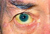 Jaundiced eye in a man with liver & colon cancer