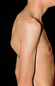 Thoracic kyphosis in teenage boy (arms lowered)