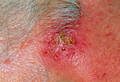 Solar keratosis skin disorder