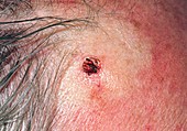Seborrhoeic keratosis (wart) after cautery removal