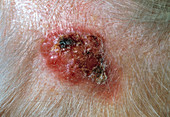 Seborrhoeic wart