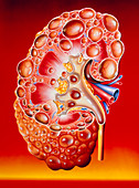 Illustration of a polycystic kidney