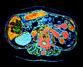 False-colour CT scan of a kidney cyst