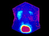 Coloured Gamma Scan showing urine reflux to kidney