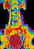 Coloured urogram showing reflux of urine to kidney