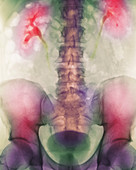 Coloured X-ray of a kidney stone in a ureter