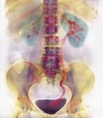 Kidney stone in ureter