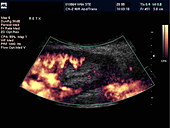 Transplanted kidney,Doppler ultrasound