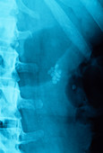 Kidney stones,X-ray