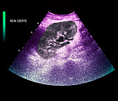 Transplanted kidney,ultrasound scan