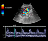 Transplanted kidney,doppler ultrasound