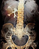 Staghorn kidney stone,X-ray