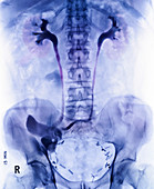 Ileal conduit surgery,X-ray