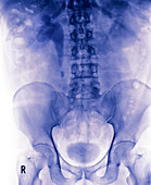 Kidney stone,X-ray