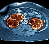 Polycystic kidneys,MRI scan