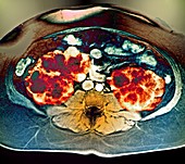 Polycystic kidneys,MRI scan