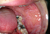 Lichen planus on inside of mouth