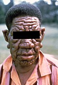 Leprosy affecting the face of a man