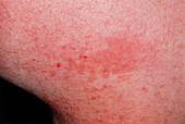 Close up of lichen planus on skin